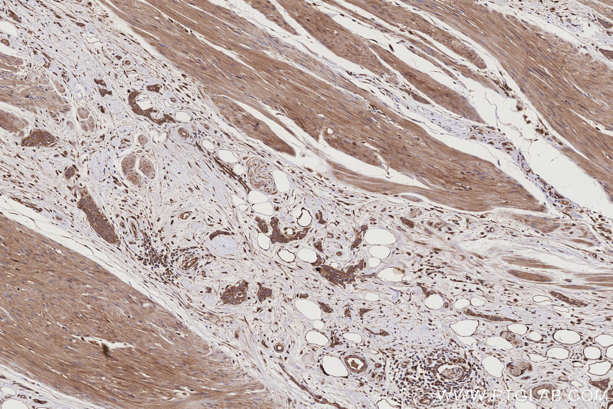 Immunohistochemical analysis of paraffin-embedded human urothelial carcinoma tissue slide using KHC3188 (NQO2 IHC Kit). Immunohistochemical analysis of paraffin-embedded human urothelial carcinoma tissue slide using KHC3188 (NQO2 IHC Kit).