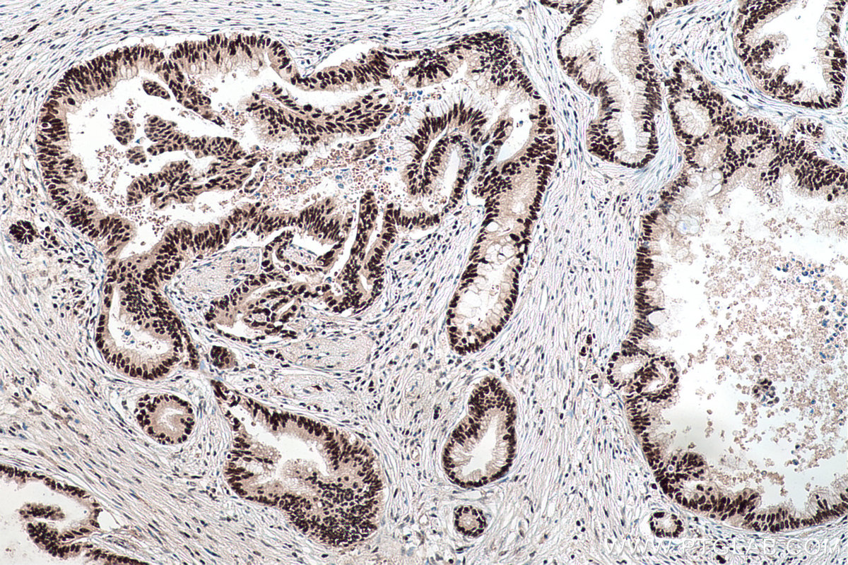 Immunohistochemical analysis of paraffin-embedded human pancreas cancer tissue slide using KHC0172 (NSUN2 IHC Kit).