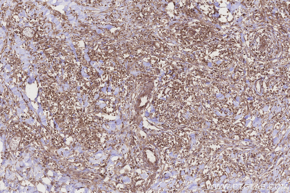 Immunohistochemical analysis of paraffin-embedded human colon cancer tissue slide using KHC3219 (NT5C2 IHC Kit). Immunohistochemical analysis of paraffin-embedded human colon cancer tissue slide using KHC3219 (NT5C2 IHC Kit).