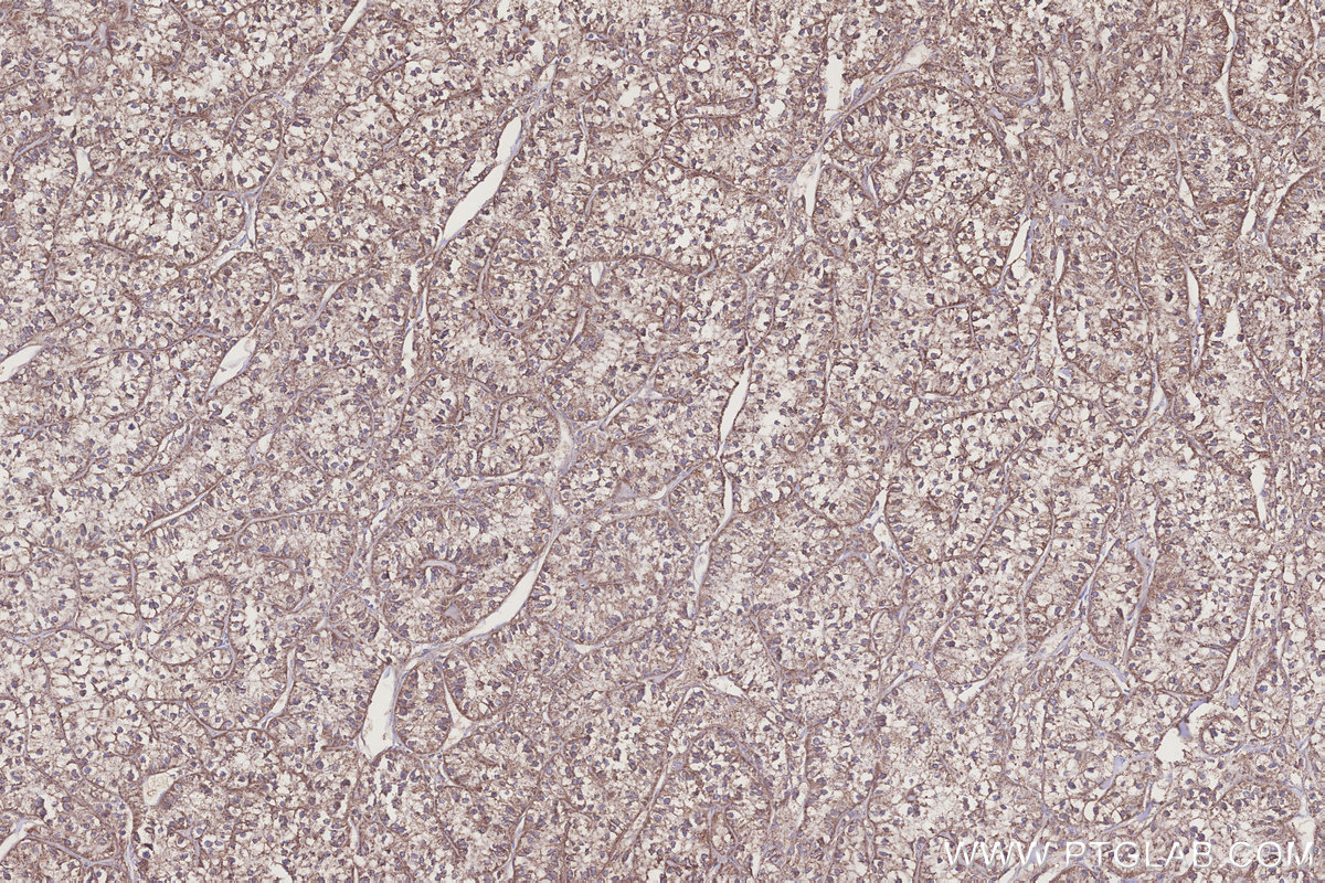 Immunohistochemical analysis of paraffin-embedded human renal cell carcinoma tissue slide using KHC3226 (NUBP1 IHC Kit).