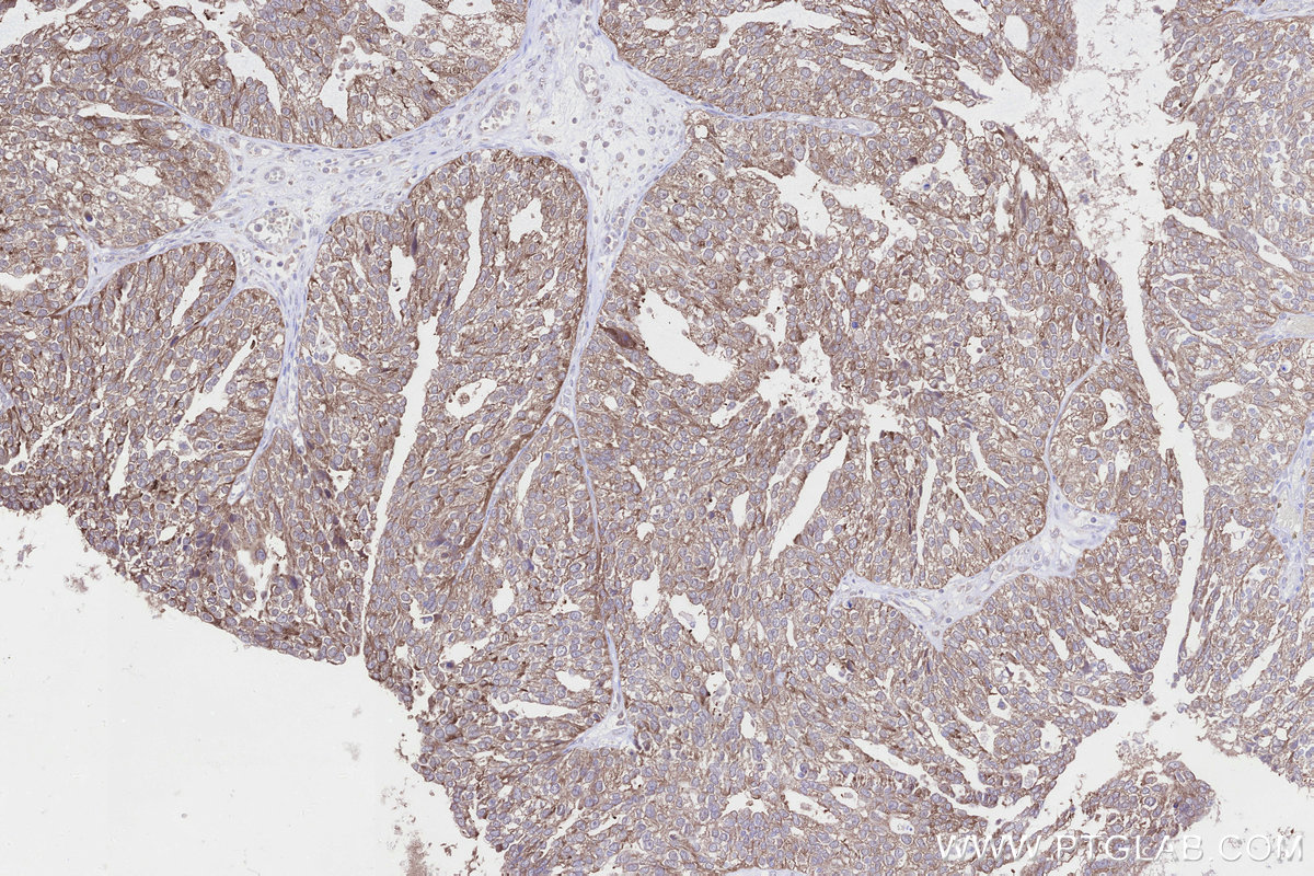 Immunohistochemical analysis of paraffin-embedded human ovary cancer tissue slide using KHC3301 (NUBPL IHC Kit). Immunohistochemical analysis of paraffin-embedded human ovary cancer tissue slide using KHC3301 (NUBPL IHC Kit).