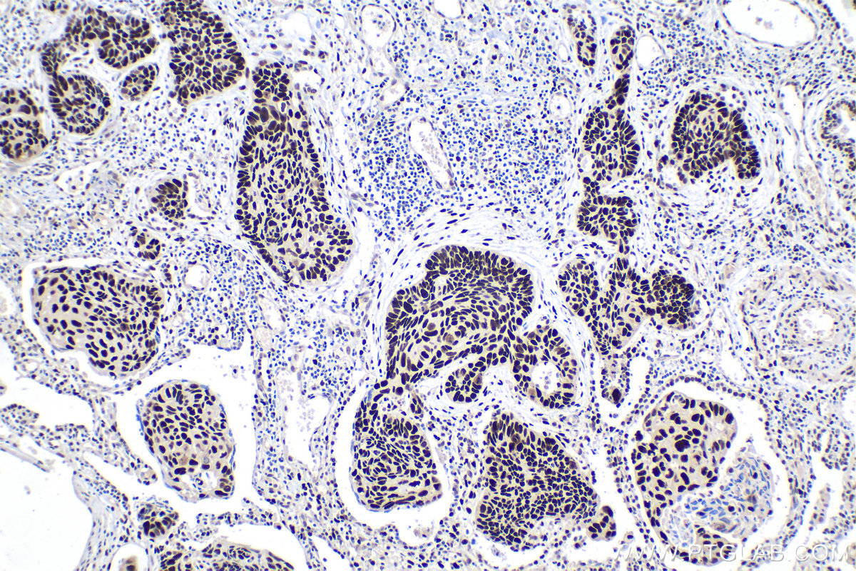 Immunohistochemical analysis of paraffin-embedded human lung cancer tissue slide using KHC1927 (NUCKS1 IHC Kit).