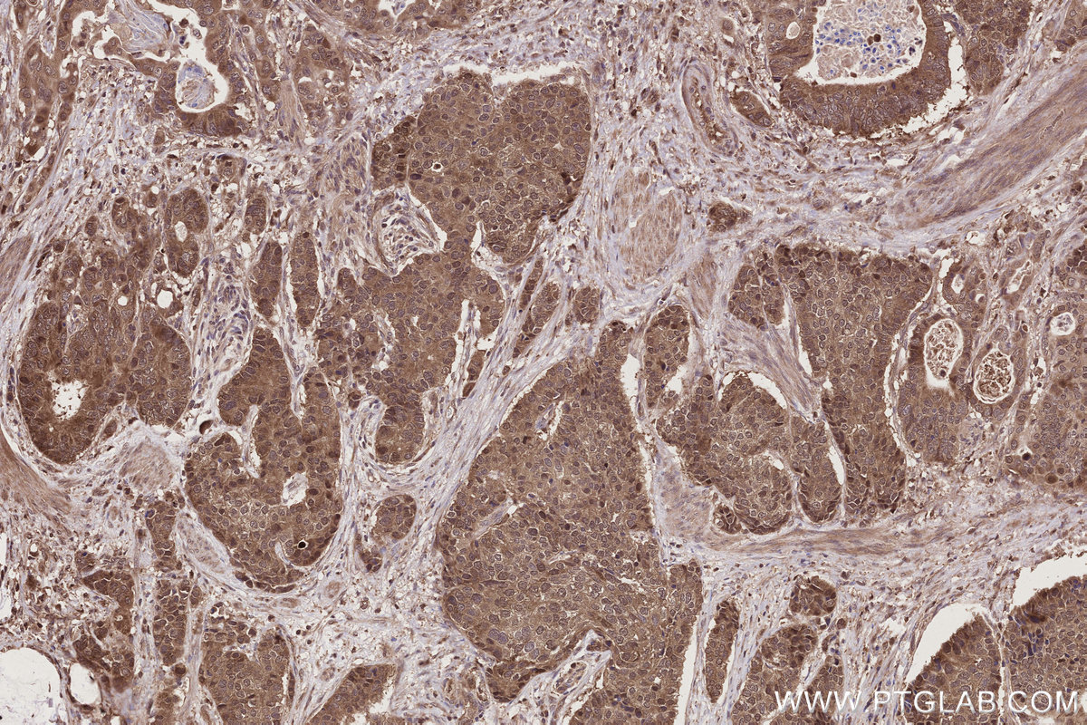 Immunohistochemical analysis of paraffin-embedded human stomach cancer tissue slide using KHC2786 (NUDT16 IHC Kit).