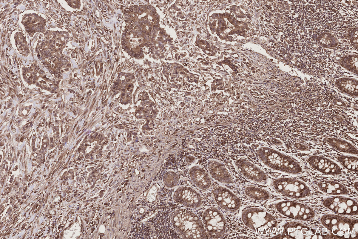 Immunohistochemical analysis of paraffin-embedded human rectal cancer tissue slide using KHC2786 (NUDT16 IHC Kit).