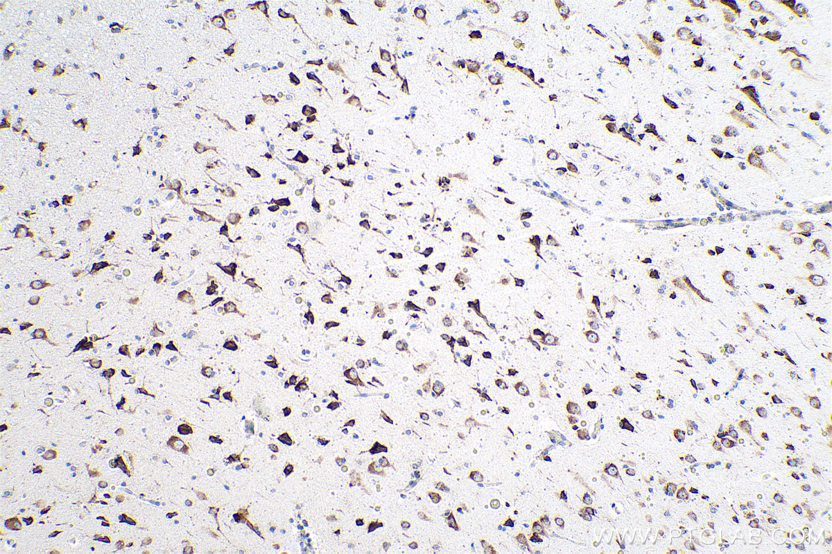 Immunohistochemical analysis of paraffin-embedded human gliomas tissue slide using KHC0958 (NUFIP2 IHC Kit).