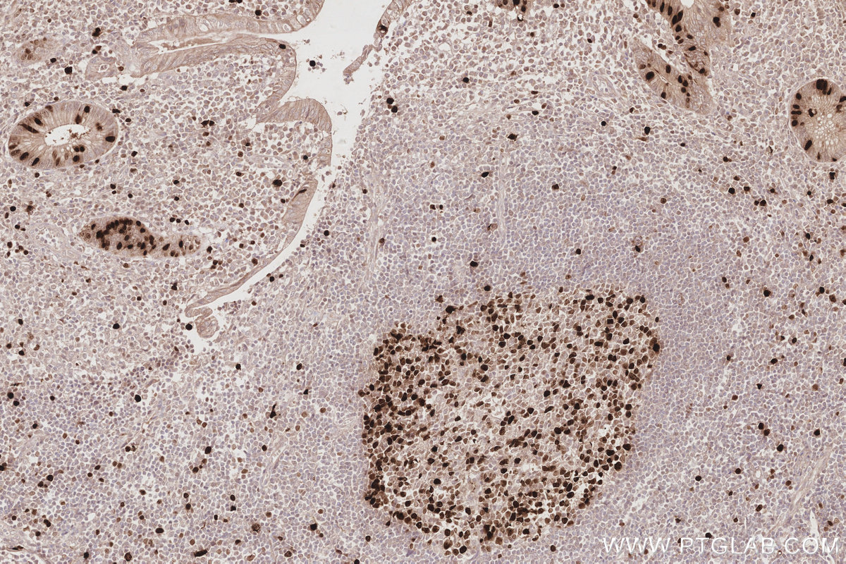 Immunohistochemical analysis of paraffin-embedded human appendicitis tissue slide using KHC2883 (NUSAP1 IHC Kit).