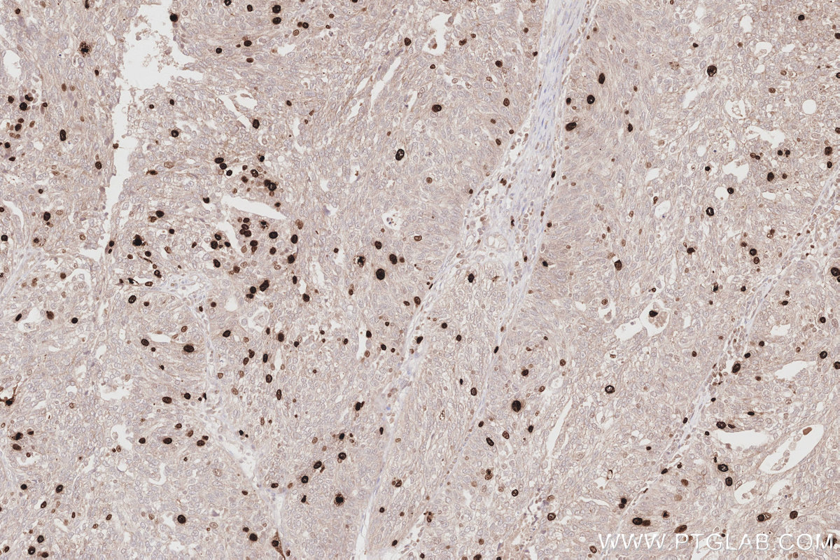 Immunohistochemical analysis of paraffin-embedded human ovary cancer tissue slide using KHC2883 (NUSAP1 IHC Kit).
