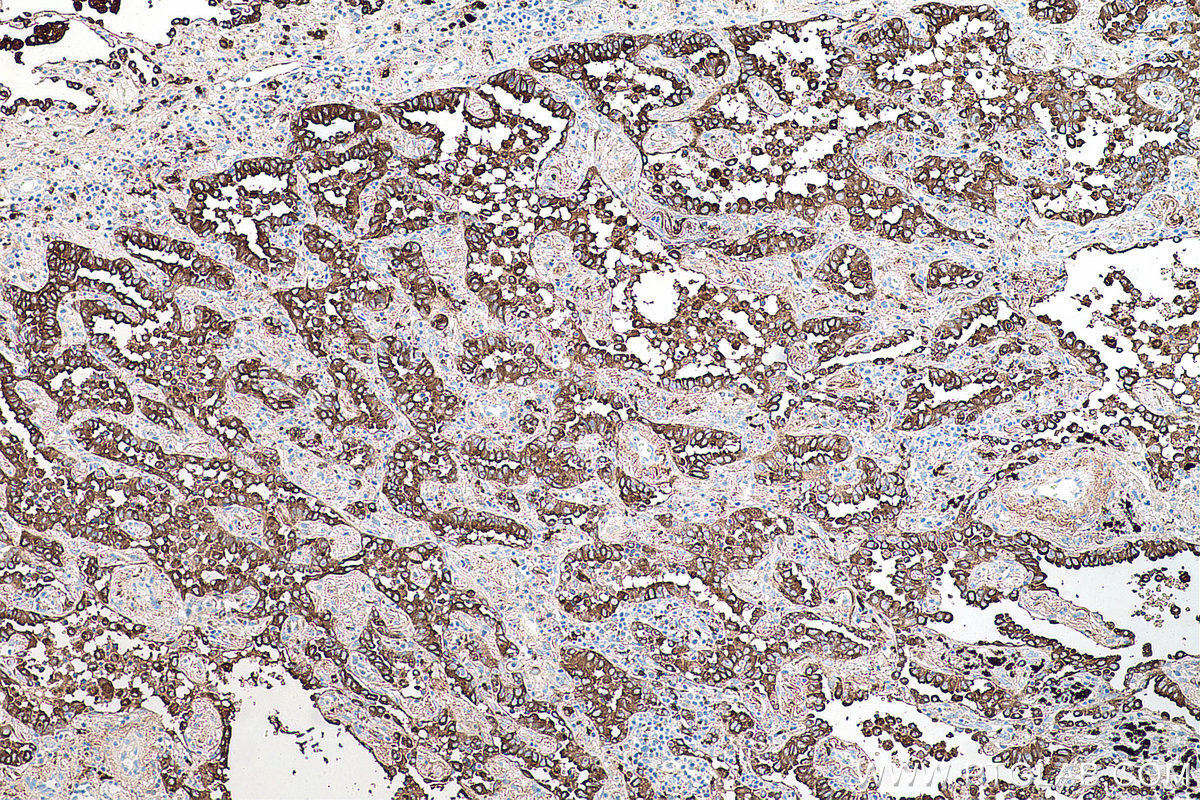 Immunohistochemical analysis of paraffin-embedded human lung cancer tissue slide using KHC0068 (Napsin A IHC Kit).