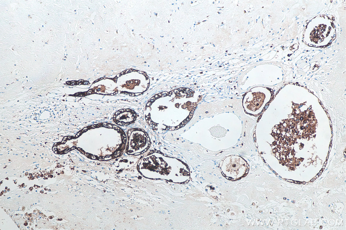 Immunohistochemical analysis of paraffin-embedded human clear cell ovarian carcinoma tissue slide using KHC0068 (Napsin A IHC Kit).