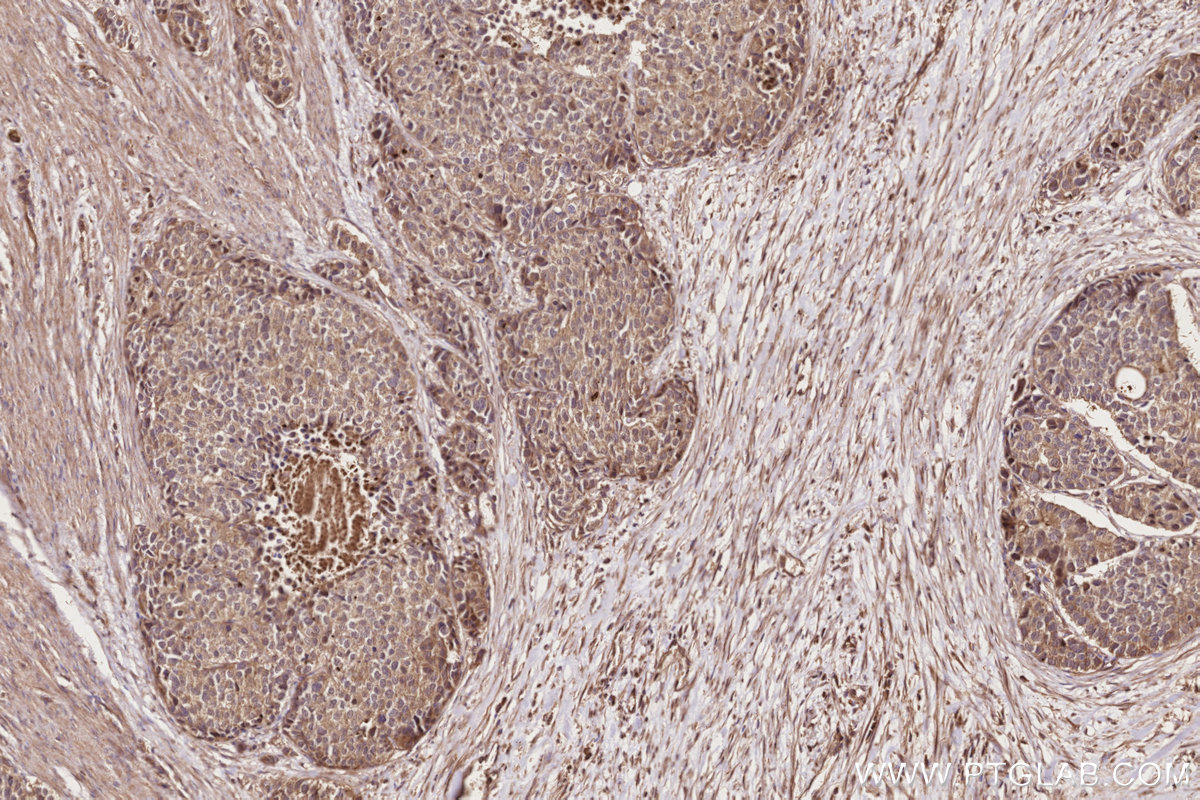 Immunohistochemical analysis of paraffin-embedded human stomach cancer tissue slide using KHC2833 (Neurabin 2 IHC Kit).