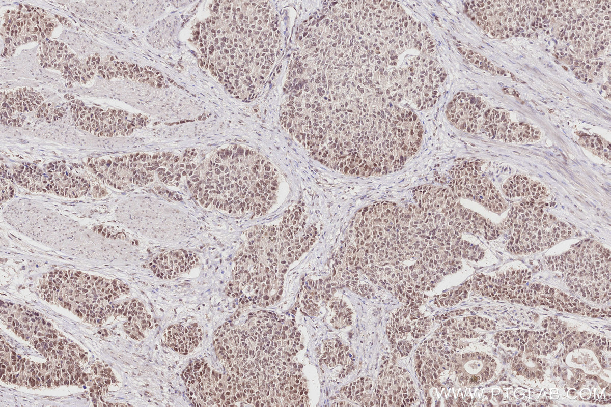 Immunohistochemical analysis of paraffin-embedded human stomach cancer tissue slide using KHC2853 (OBFC2B IHC Kit).