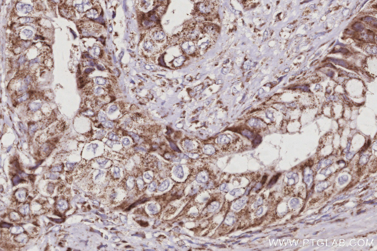 Immunohistochemical analysis of paraffin-embedded human pancreas cancer tissue slide using KHC3034 (OGDHL IHC Kit).