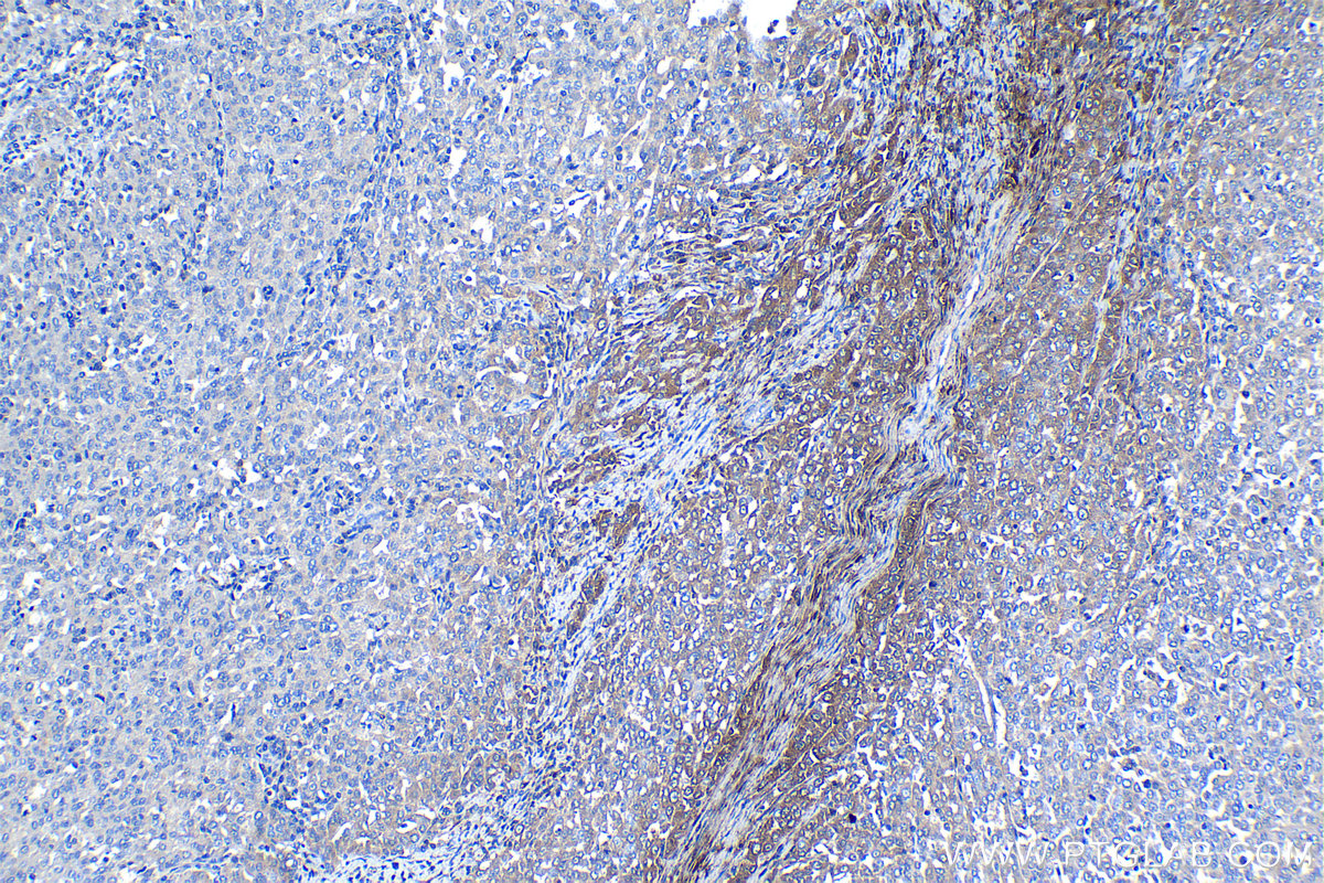 Immunohistochemical analysis of paraffin-embedded human ovary tumor tissue slide using KHC1277 (OGN IHC Kit).
