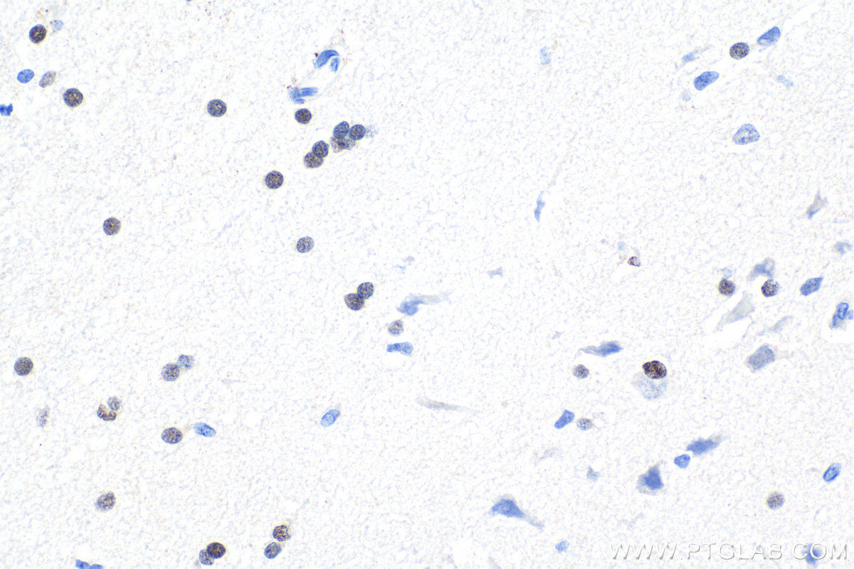Immunohistochemical analysis of paraffin-embedded human gliomas tissue slide using KHC1715 (OLIG2 IHC Kit).