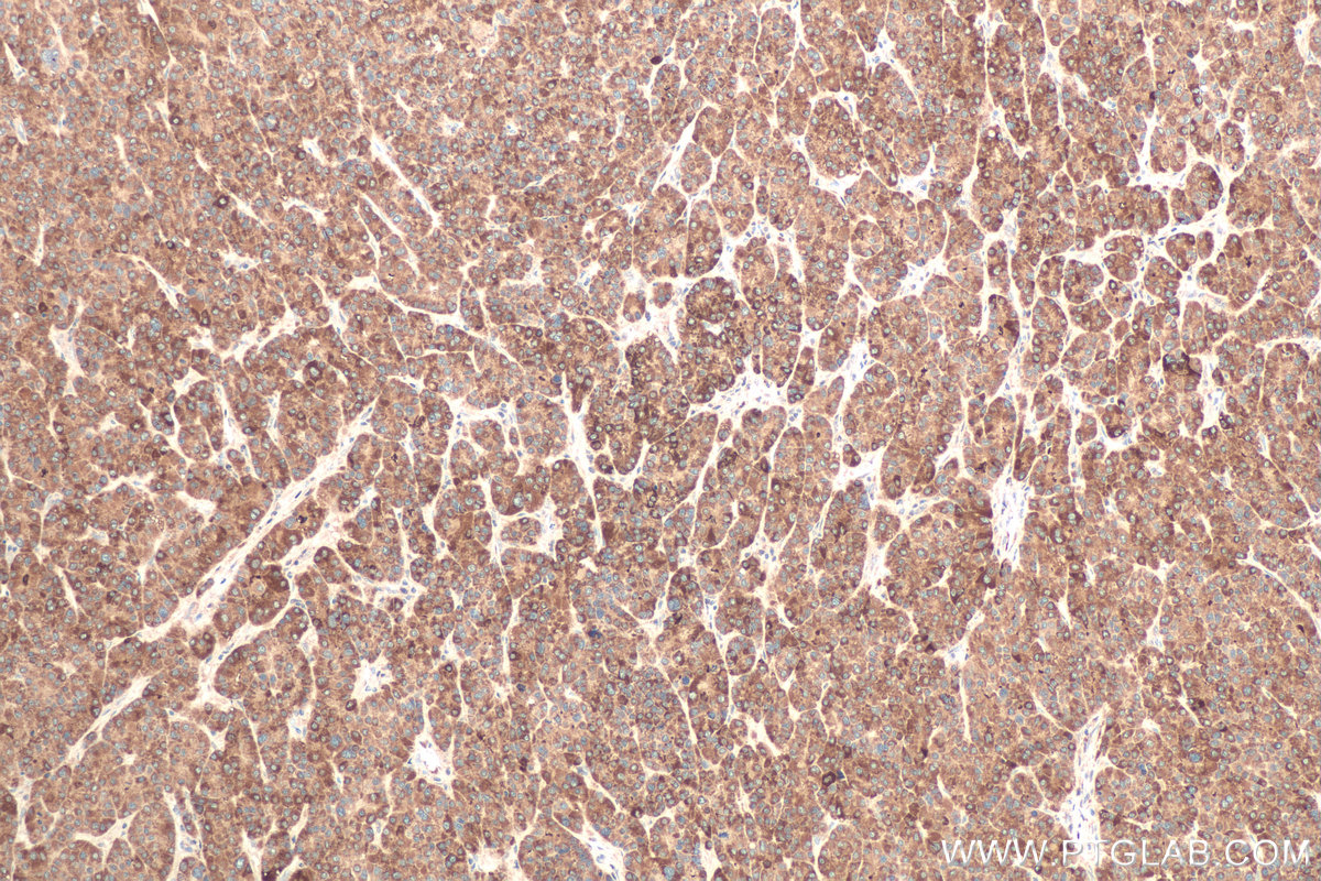 Immunohistochemical analysis of paraffin-embedded human liver cancer tissue slide using KHC0716 (ORM2 IHC Kit).