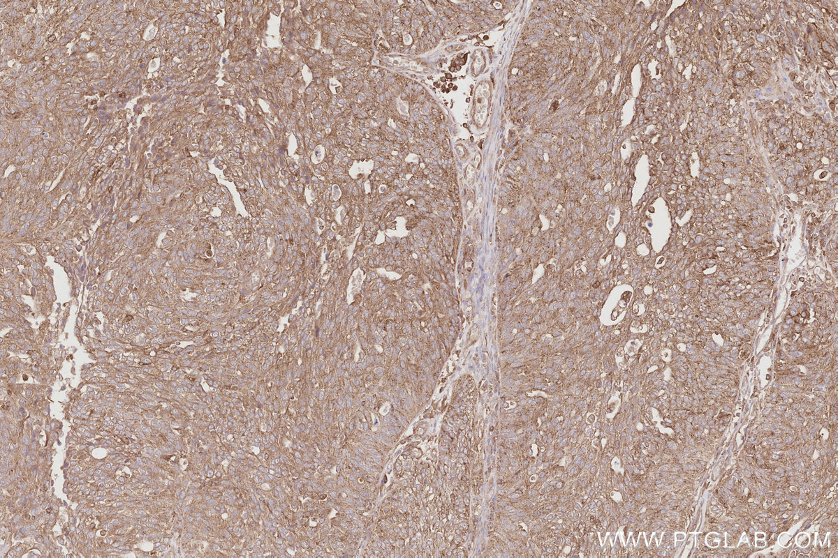 Immunohistochemical analysis of paraffin-embedded human ovary cancer tissue slide using KHC2880 (OSBPL11 IHC Kit).