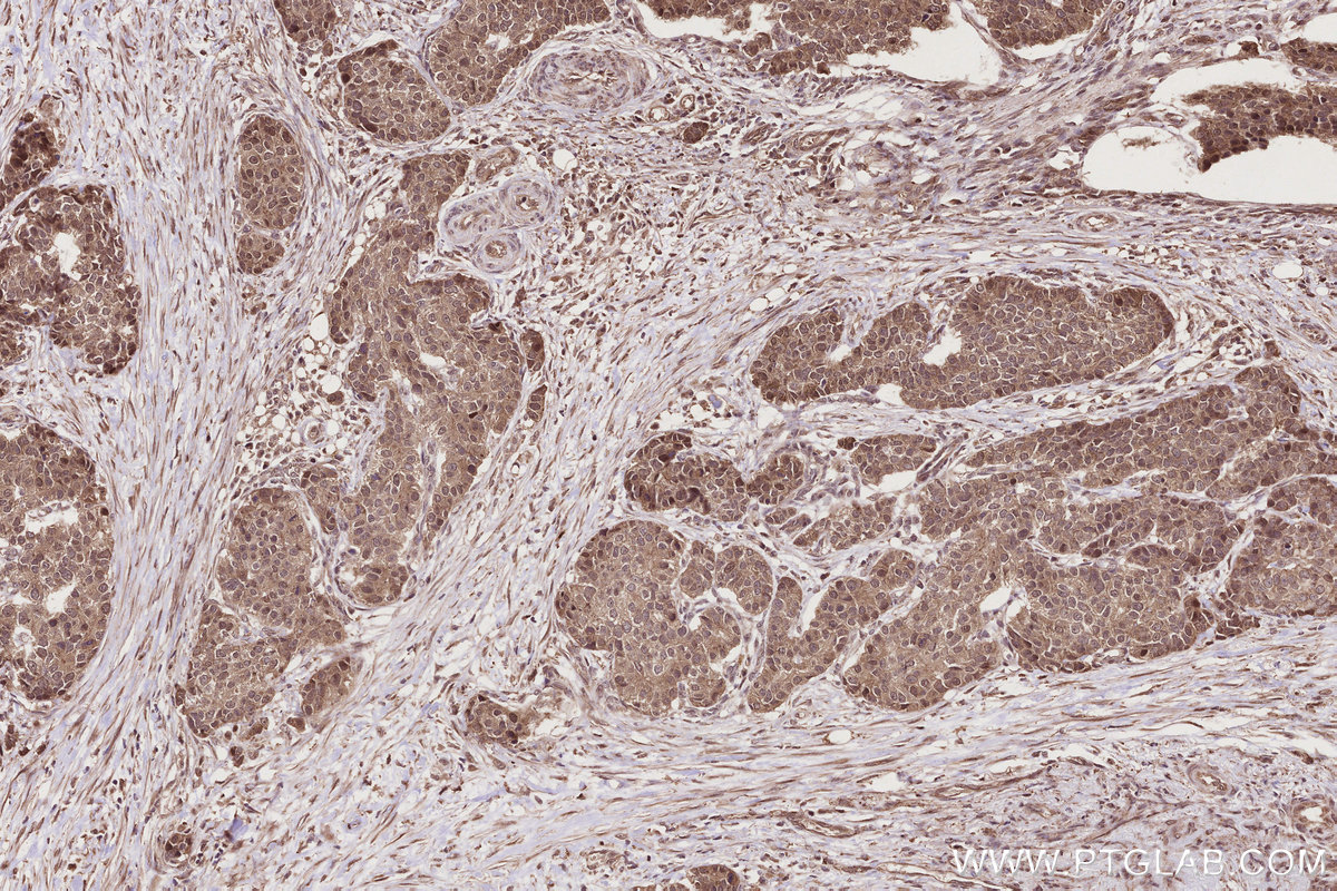 Immunohistochemical analysis of paraffin-embedded human stomach cancer tissue slide using KHC2793 (OTUD5 IHC Kit).