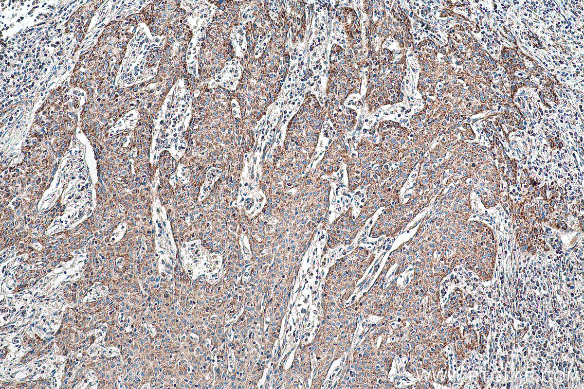 Immunohistochemical analysis of paraffin-embedded human cervical cancer tissue slide using KHC0888 (OXCT1 IHC Kit).