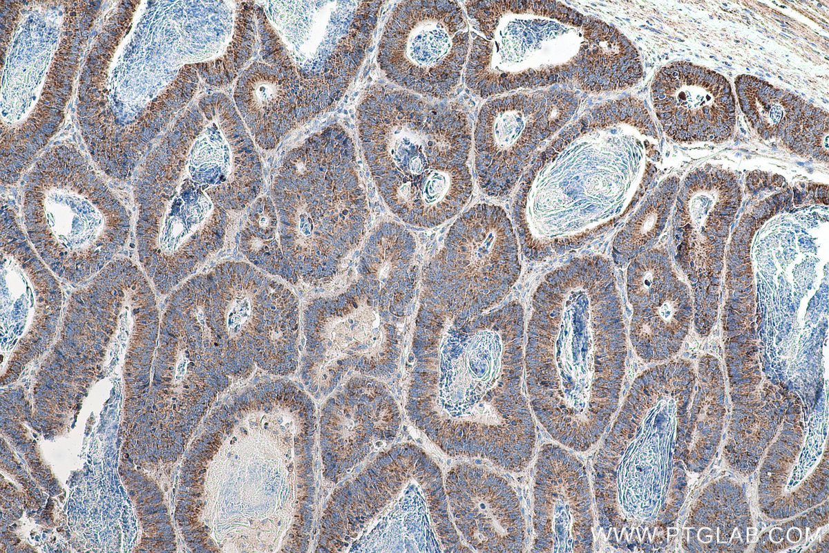 Immunohistochemical analysis of paraffin-embedded human colon cancer tissue slide using KHC0888 (OXCT1 IHC Kit).