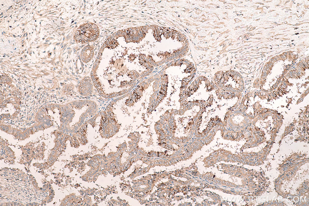 Immunohistochemical analysis of paraffin-embedded human ovary tumor tissue slide using KHC0782 (Osteopontin/SPP1 IHC Kit).