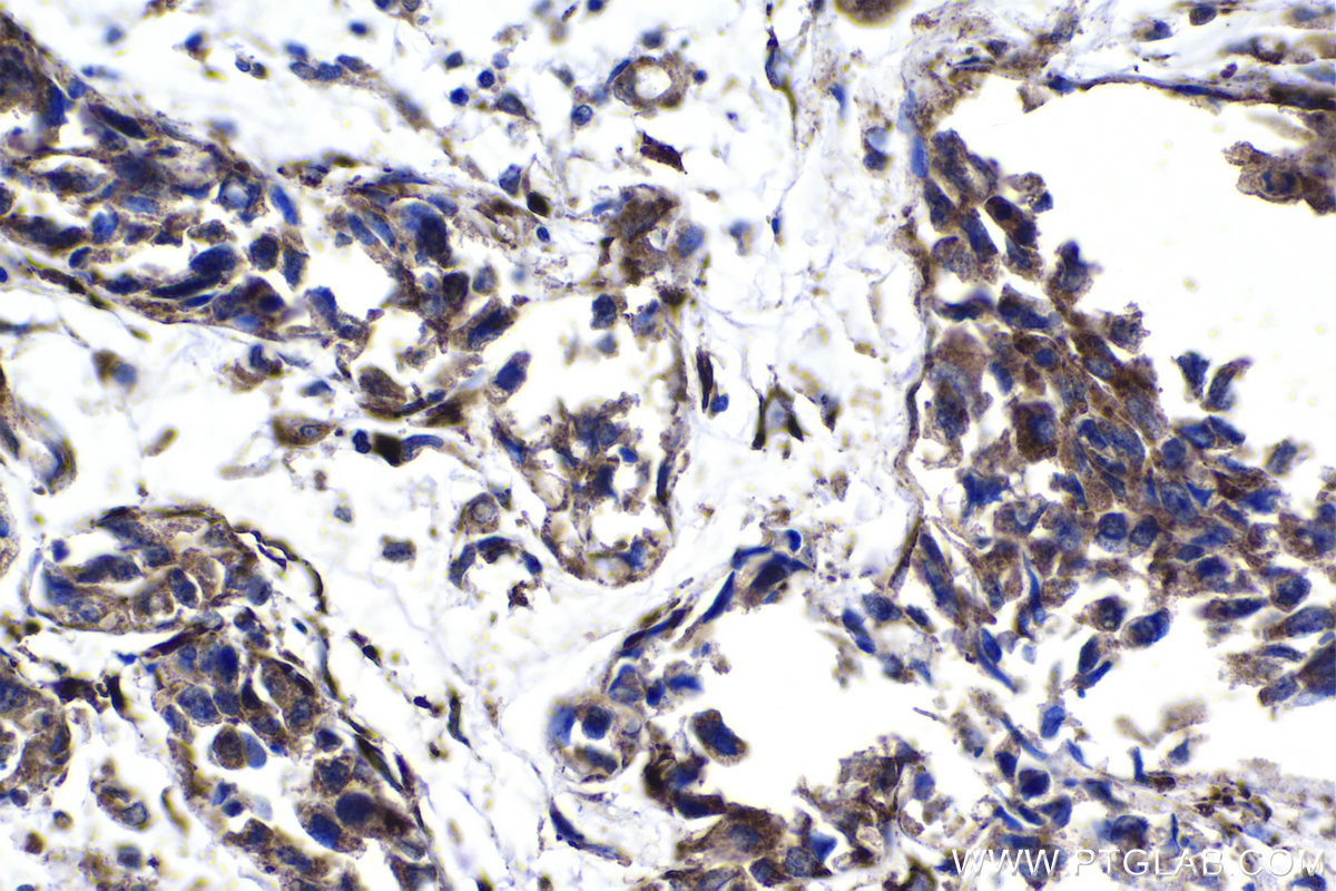 Immunohistochemical analysis of paraffin-embedded human breast cancer tissue slide using KHC1369 (P4HA2 IHC Kit).