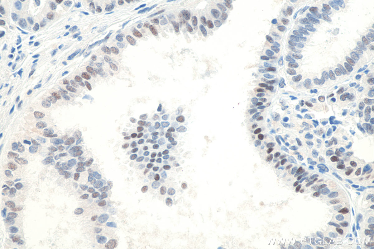 Immunohistochemical analysis of paraffin-embedded human ovary tumor tissue slide using KHC0079 (P53 IHC Kit).
