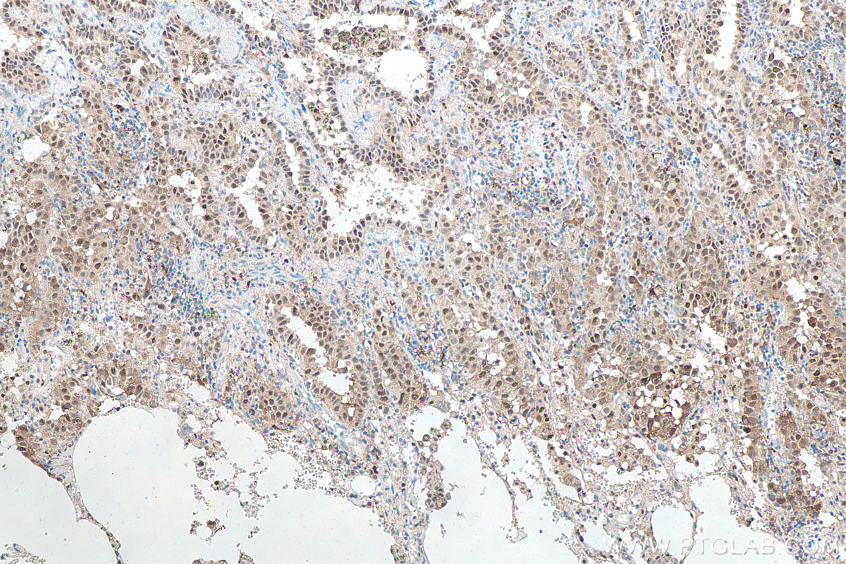 Immunohistochemical analysis of paraffin-embedded human lung cancer tissue slide using KHC0058 (P62,SQSTM1 IHC Kit).