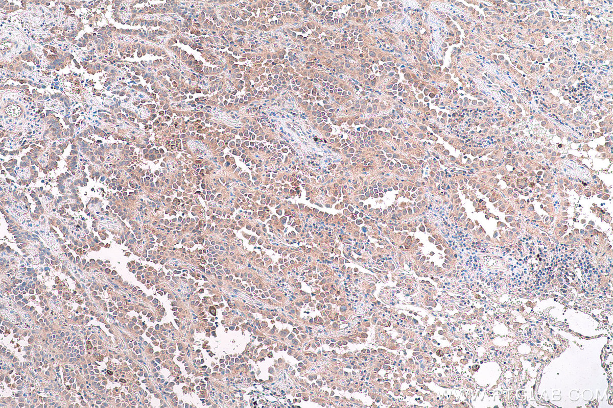 Immunohistochemical analysis of paraffin-embedded human lung cancer tissue slide using KHC0853 (PA2G4 IHC Kit).