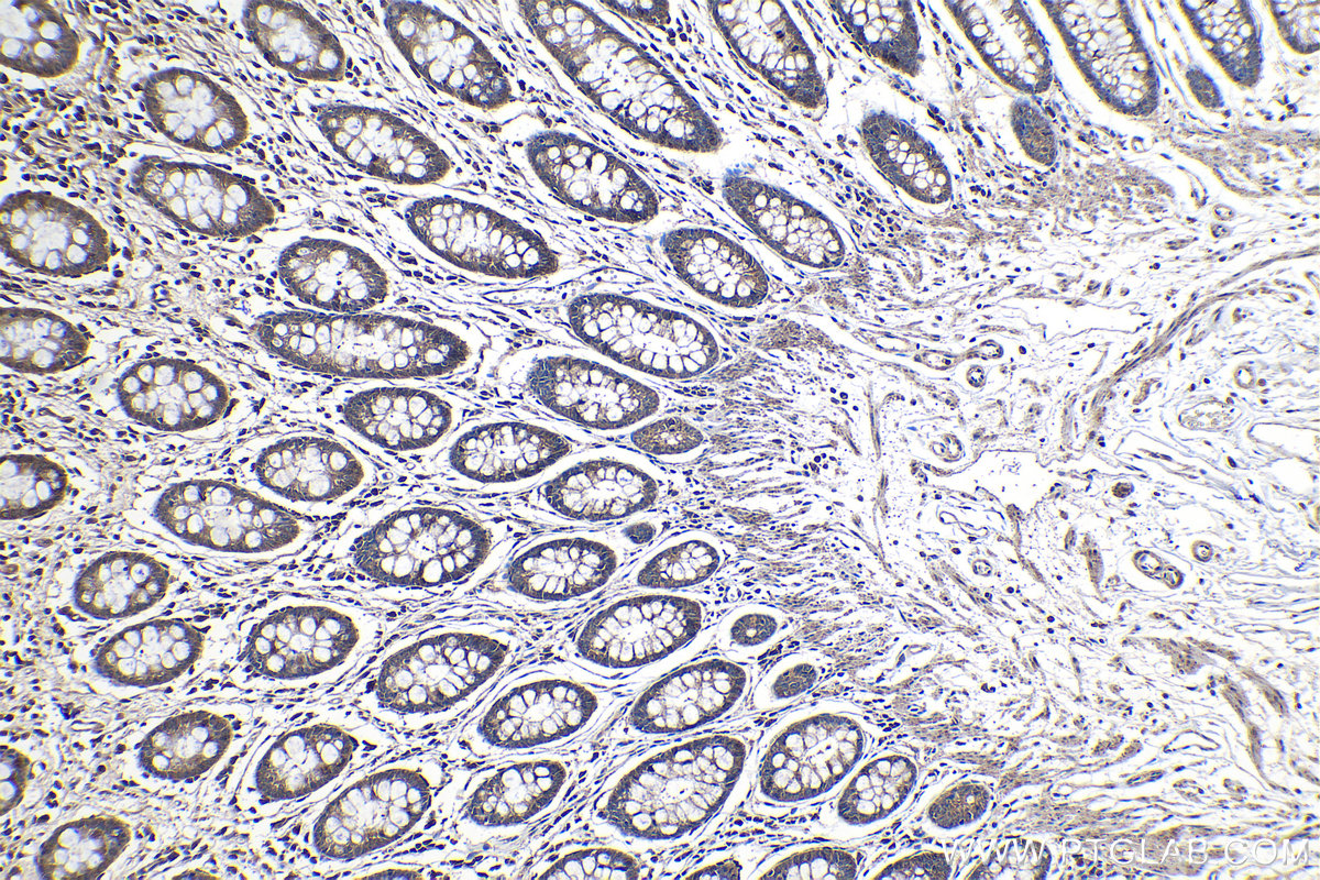 Immunohistochemical analysis of paraffin-embedded human colon tissue slide using KHC1141 (PABPC1 IHC Kit).