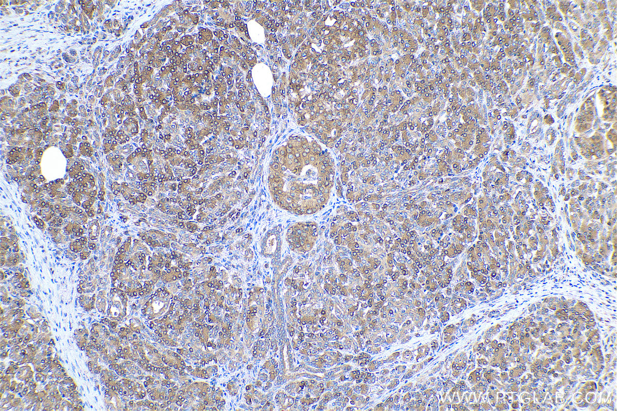 Immunohistochemical analysis of paraffin-embedded human pancreas cancer tissue slide using KHC0908 (PABPC4 IHC Kit).