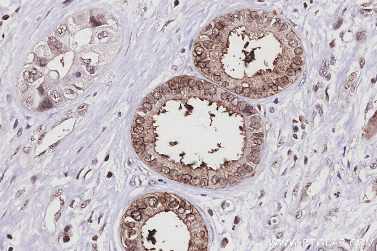 Immunohistochemical analysis of paraffin-embedded human pancreas cancer tissue slide using KHC2944 (PAK6 IHC Kit).