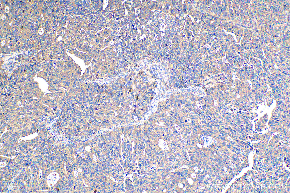 Immunohistochemical analysis of paraffin-embedded human ovary tumor tissue slide using KHC1321 (PAPPA IHC Kit).