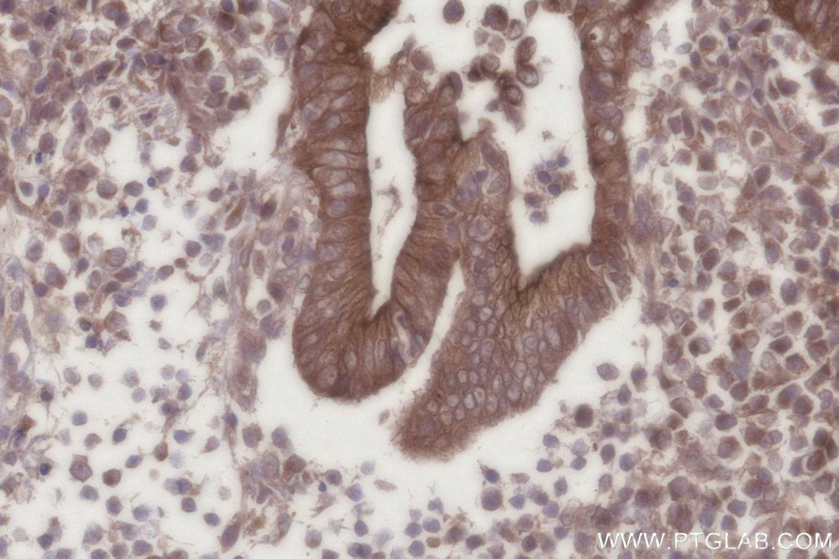 Immunohistochemical analysis of paraffin-embedded human appendicitis tissue slide using KHC2726 (PARD3 IHC Kit).
