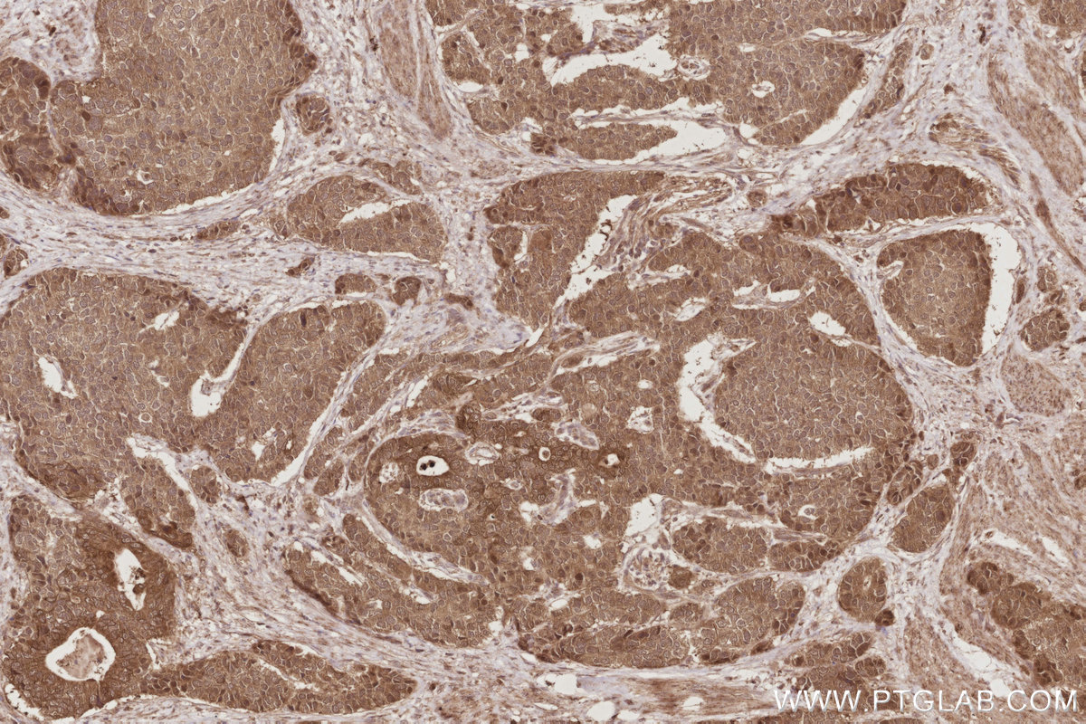 Immunohistochemical analysis of paraffin-embedded human stomach cancer tissue slide using KHC2887 (PARD6B IHC Kit). Immunohistochemical analysis of paraffin-embedded human stomach cancer tissue slide using KHC2887 (PARD6B IHC Kit).
