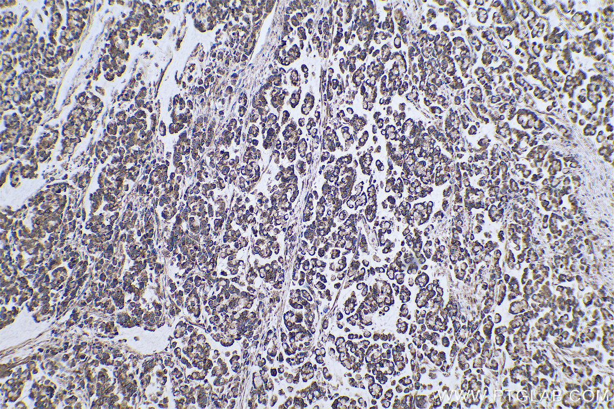 Immunohistochemical analysis of paraffin-embedded human colon cancer tissue slide using KHC0720 (PARVA IHC Kit).