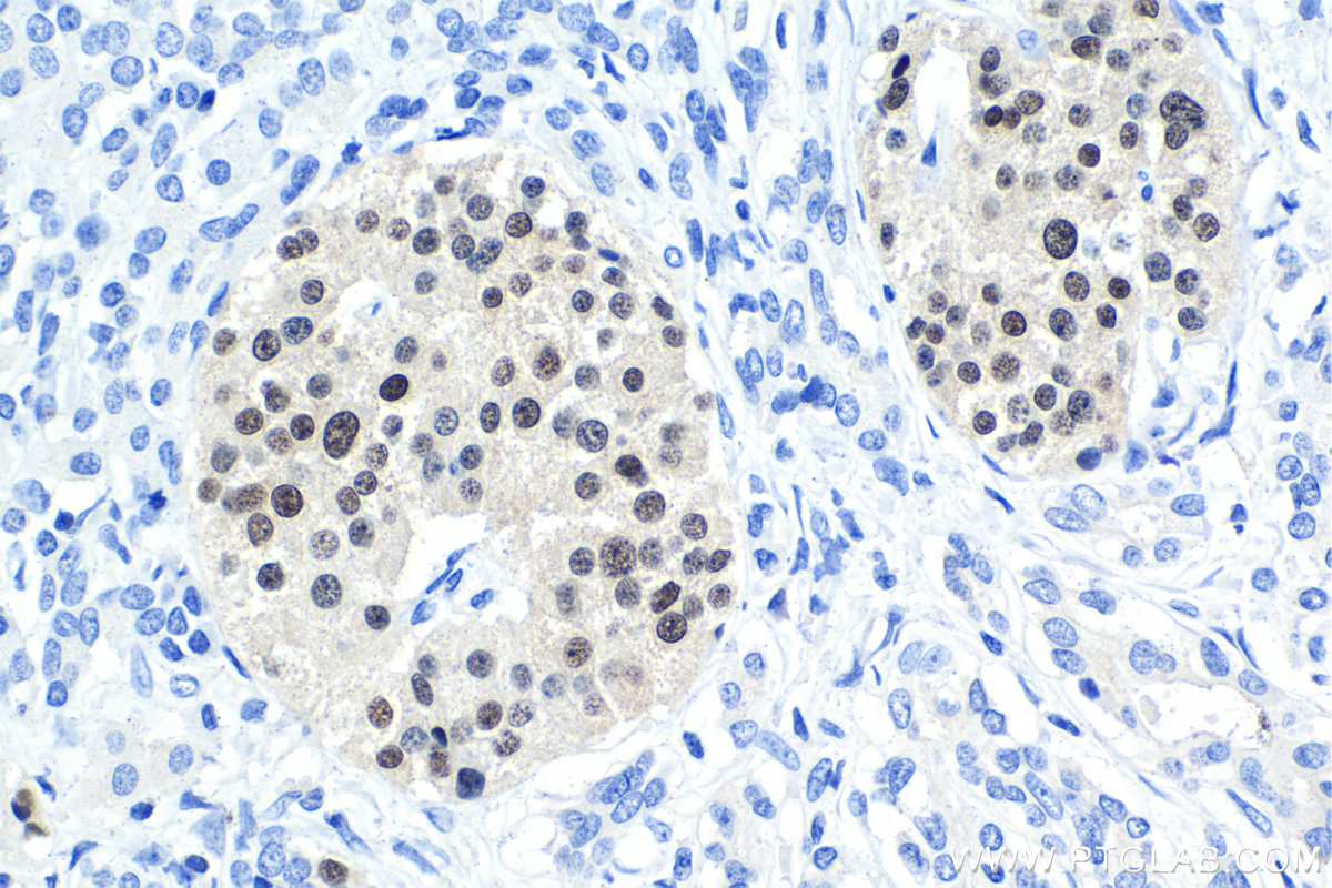 Immunohistochemical analysis of paraffin-embedded human pancreas cancer tissue slide using KHC1565 (PAX6 IHC Kit).
