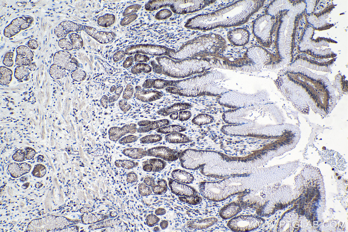 Immunohistochemical analysis of paraffin-embedded human stomach cancer tissue slide using KHC1034 (PBK IHC Kit).