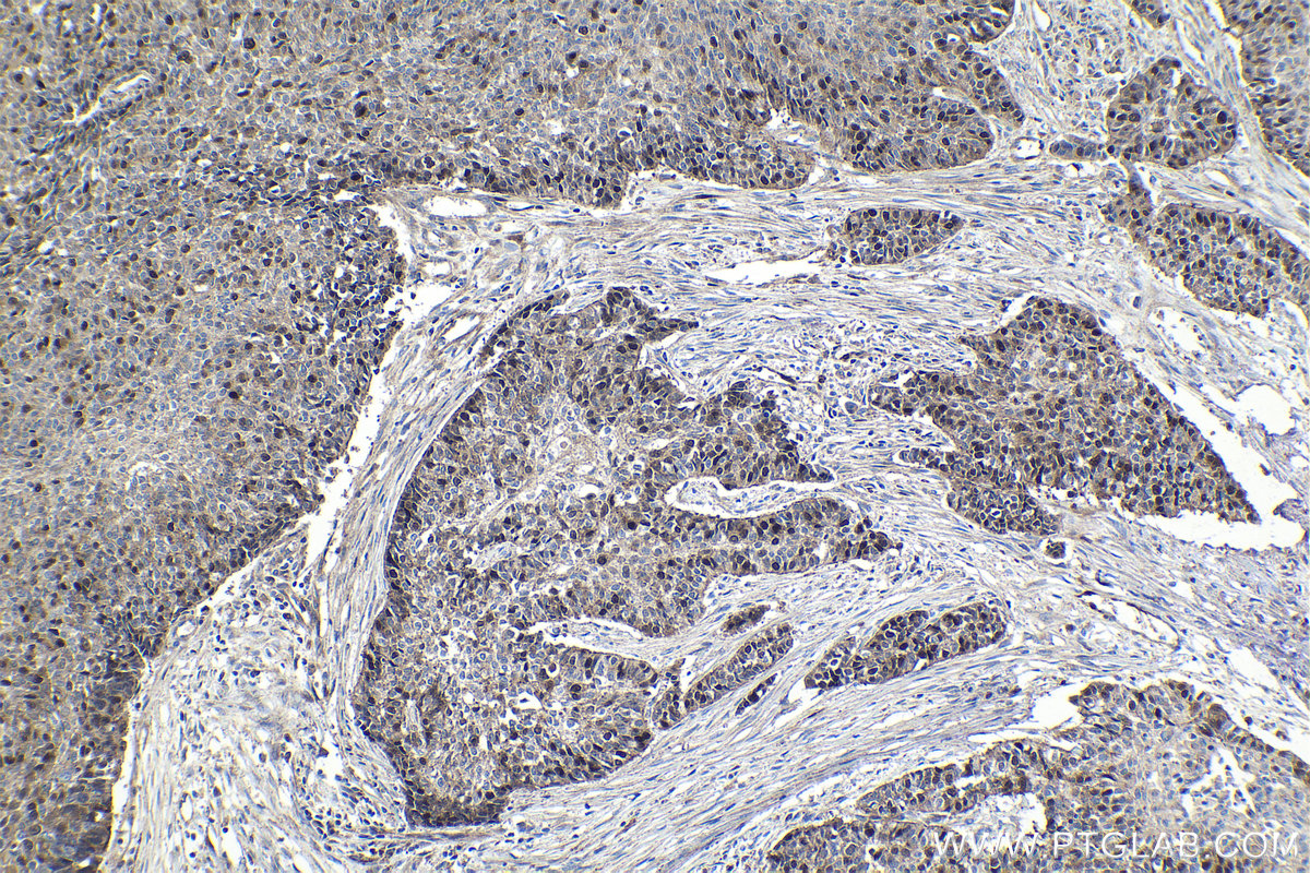 Immunohistochemical analysis of paraffin-embedded human lung cancer tissue slide using KHC1034 (PBK IHC Kit).