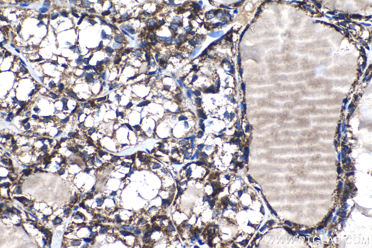 Immunohistochemical analysis of paraffin-embedded human thyroid cancer tissue slide using KHC1266 (PC IHC Kit).