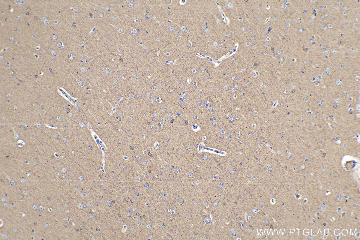 Immunohistochemical analysis of paraffin-embedded human gliomas tissue slide using KHC0256 (PCDHA5 IHC Kit).