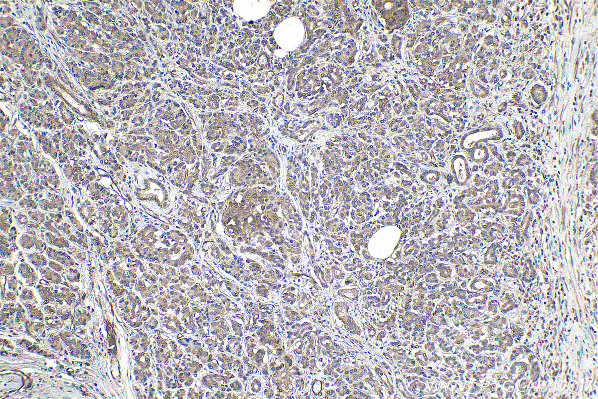 Immunohistochemical analysis of paraffin-embedded human pancreas cancer tissue slide using KHC1775 (PCID2 IHC Kit).