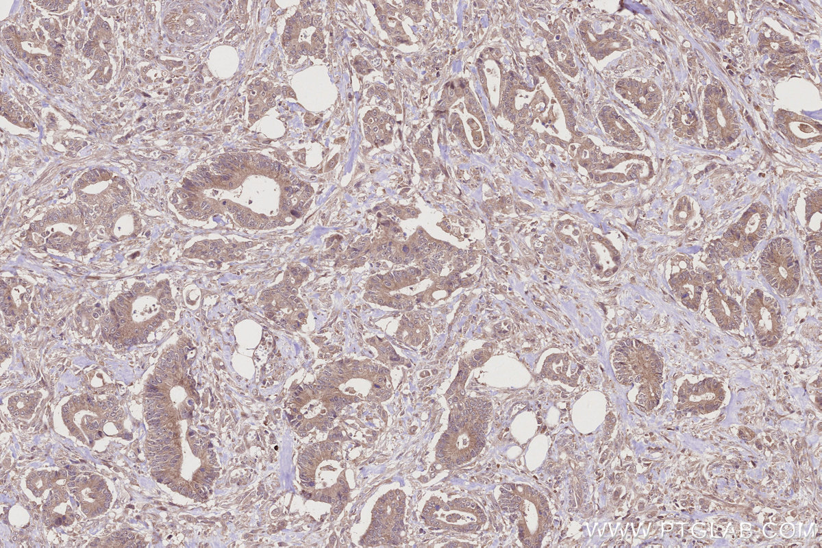 Immunohistochemical analysis of paraffin-embedded human rectal cancer tissue slide using KHC2756 (PCSK5 IHC Kit).