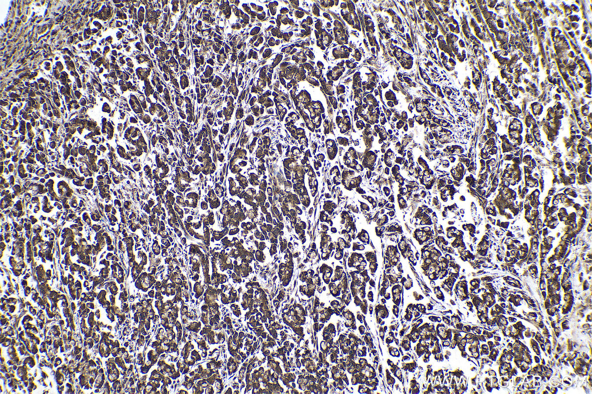Immunohistochemical analysis of paraffin-embedded human colon cancer tissue slide using KHC0957 (PDAP1 IHC Kit).