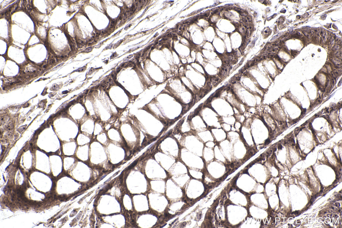Immunohistochemical analysis of paraffin-embedded human rectal cancer tissue slide using KHC2466 (PDCD11 IHC Kit).
