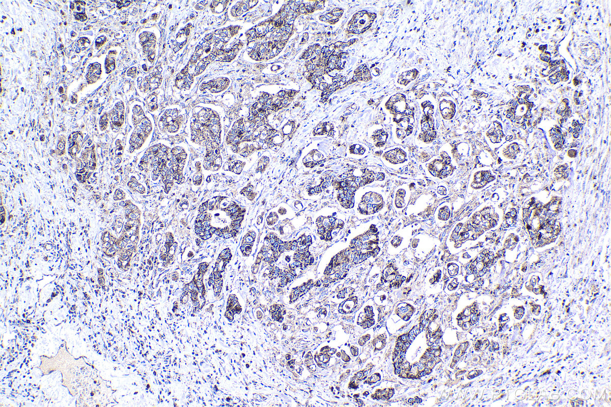 Immunohistochemical analysis of paraffin-embedded human stomach cancer tissue slide using KHC1375 (PDHX IHC Kit).