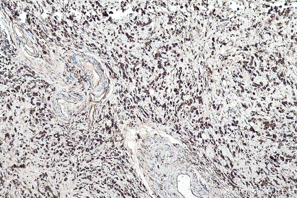 Immunohistochemical analysis of paraffin-embedded human stomach cancer tissue slide using KHC0516 (PDI/P4HB IHC Kit).