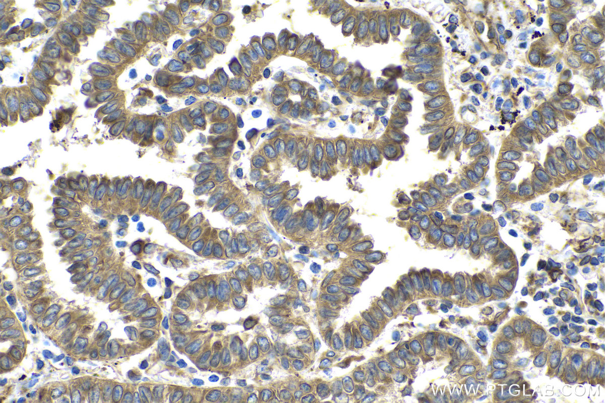 Immunohistochemical analysis of paraffin-embedded human lung cancer tissue slide using KHC0535 (PDIA3 IHC Kit).