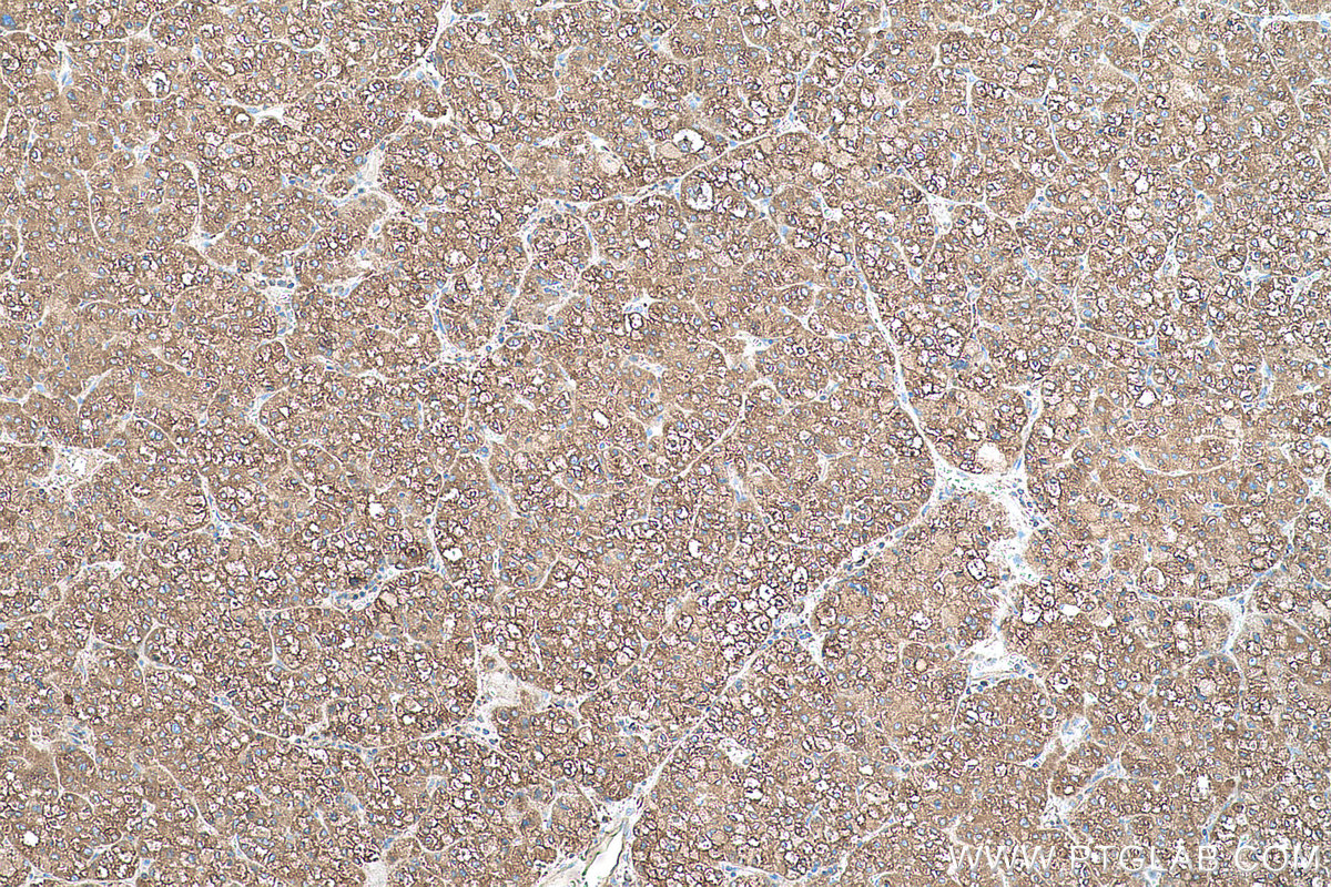 Immunohistochemical analysis of paraffin-embedded human liver cancer tissue slide using KHC0584 (PDIA4/ERP72 IHC Kit).