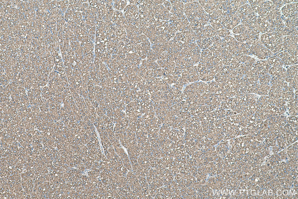 Immunohistochemical analysis of paraffin-embedded human liver cancer tissue slide using KHC0579 (PDIA6 IHC Kit).
