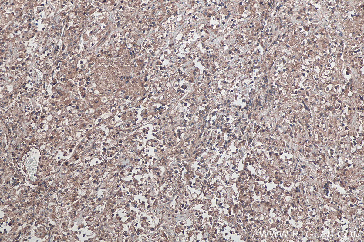 Immunohistochemical analysis of paraffin-embedded human endometrial cancer tissue slide using KHC0444 (PDLIM7 IHC Kit).